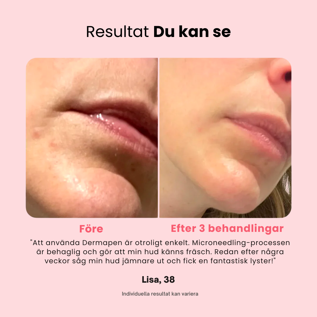 Professionell dermapen + 4 gratis gåvor