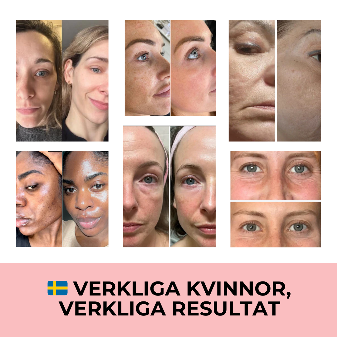 Professionell dermapen + 4 gratis gåvor