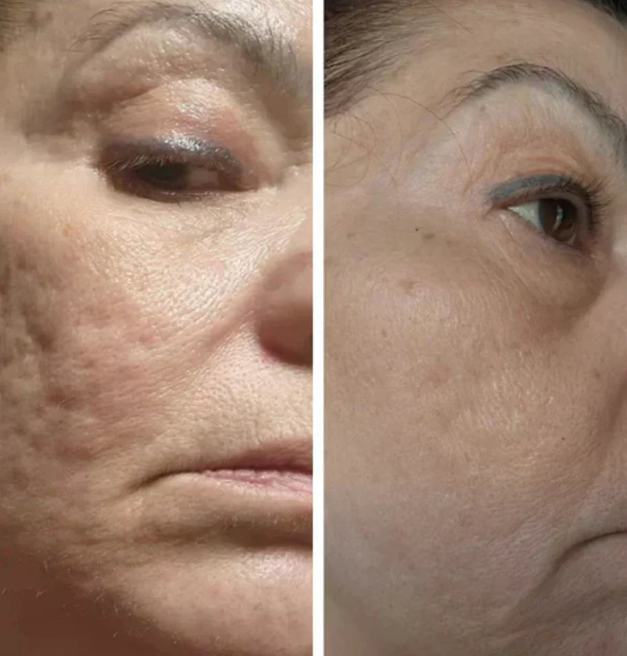 Professionell dermapen + 4 gratis gåvor