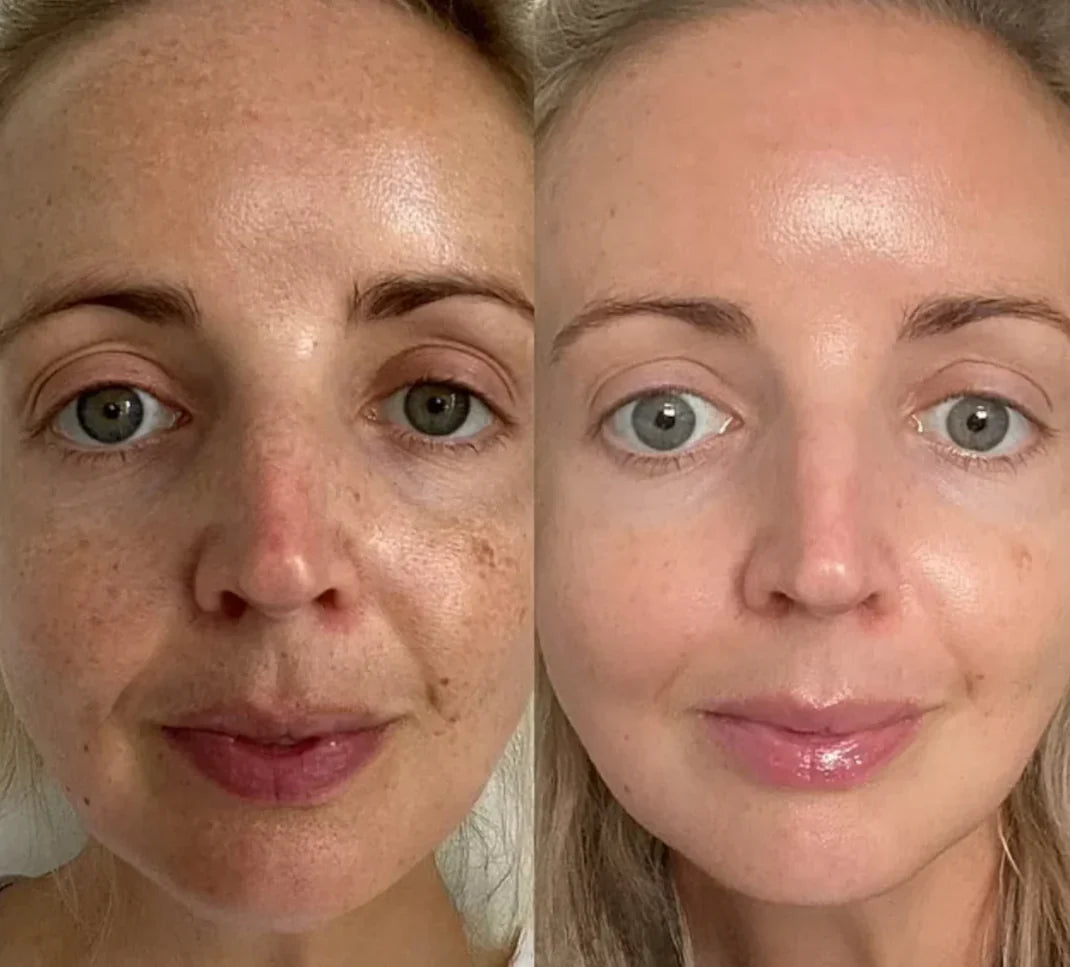 Professionell dermapen + 4 gratis gåvor