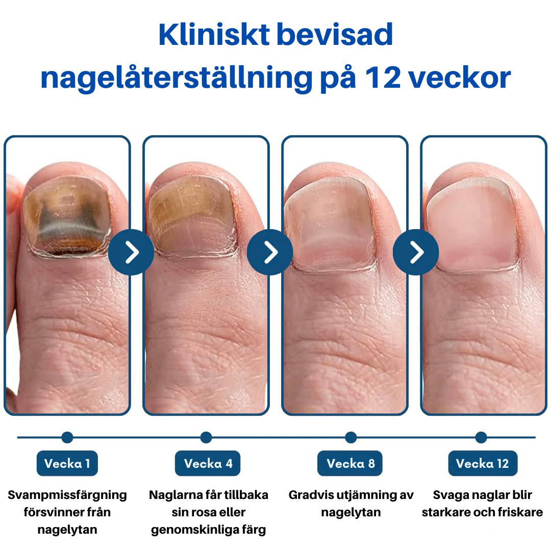 OnyClear™- Laser mot nagelsvamp