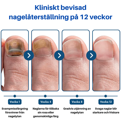 OnyClear™- Laser mot nagelsvamp
