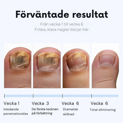 ClearNail – Nagelförnyande plåster mot svamp
